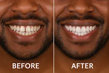 Laser Hair Removal