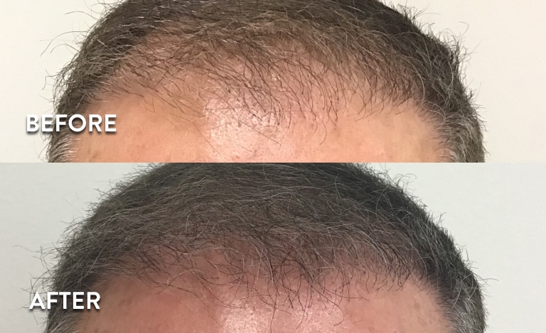 Anti-aging injectables